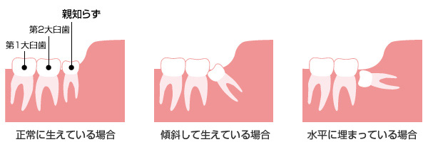 親知らず図解