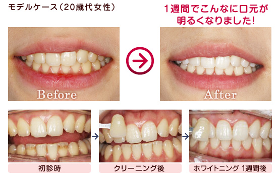 ホワイトニング | 診療内容 | 甲府デンタルクリニック｜一般歯科・虫歯