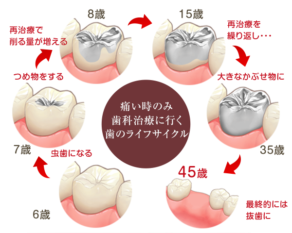 虫歯予防_ 過程