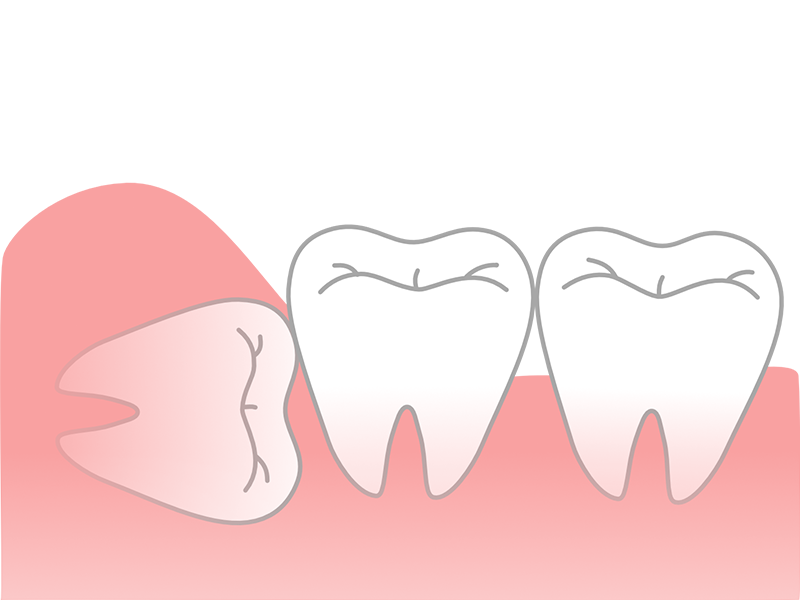 親知らずの抜歯 | 診療案内 | 甲府デンタルクリニック｜一般歯科・虫歯 