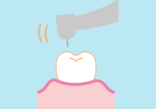 超音波スケーラー