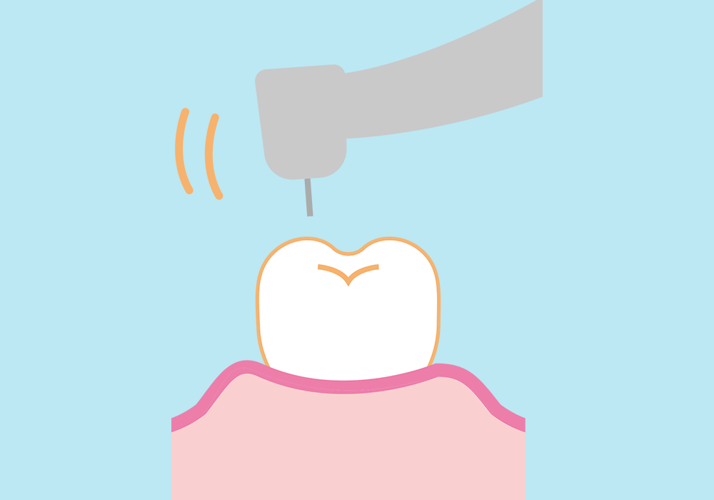 超音波スケーラー