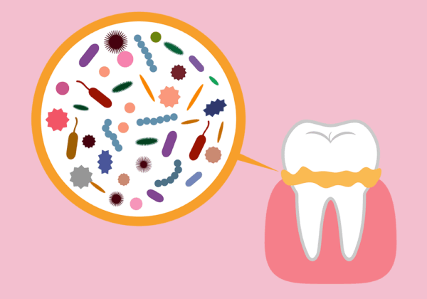 汚れがたまった歯