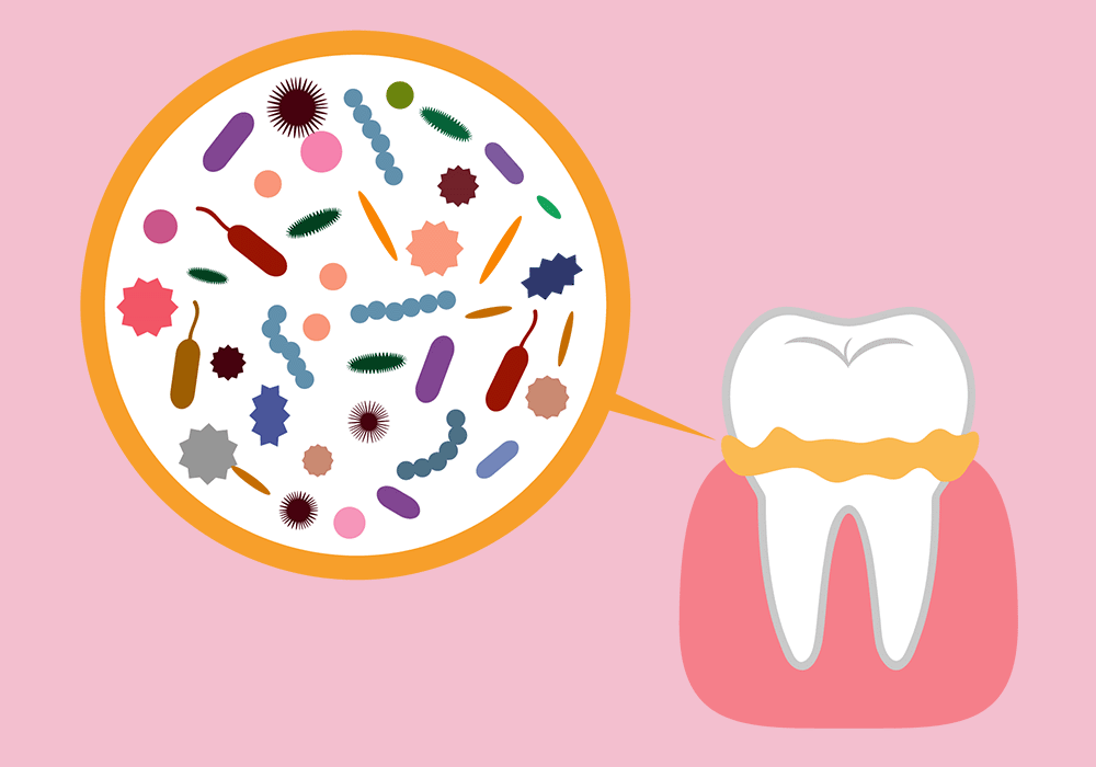 汚れがたまった歯